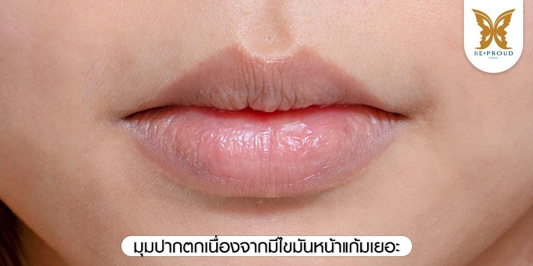 มุมปากตกเนื่องจากมีไขมันหน้าแก้มเยอะ