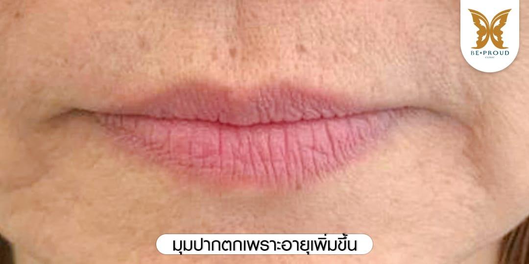 มุมปากตกเพราะอายุเพิ่มขึ้น
