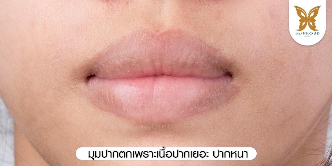 มุมปากตกเพราะเนื้อปากเยอะ ปากหนา 