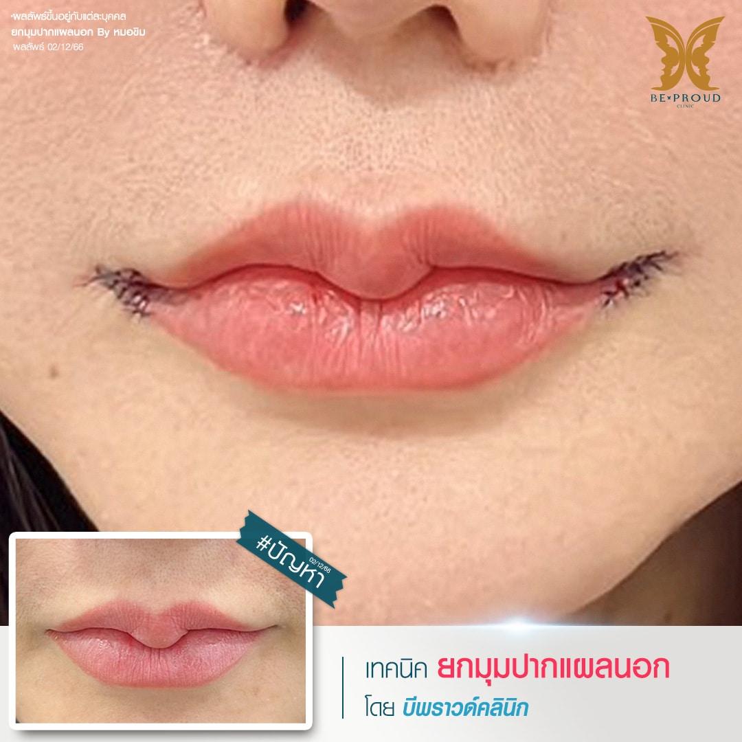 การผ่าตัดยกมุมปากแผลนอก