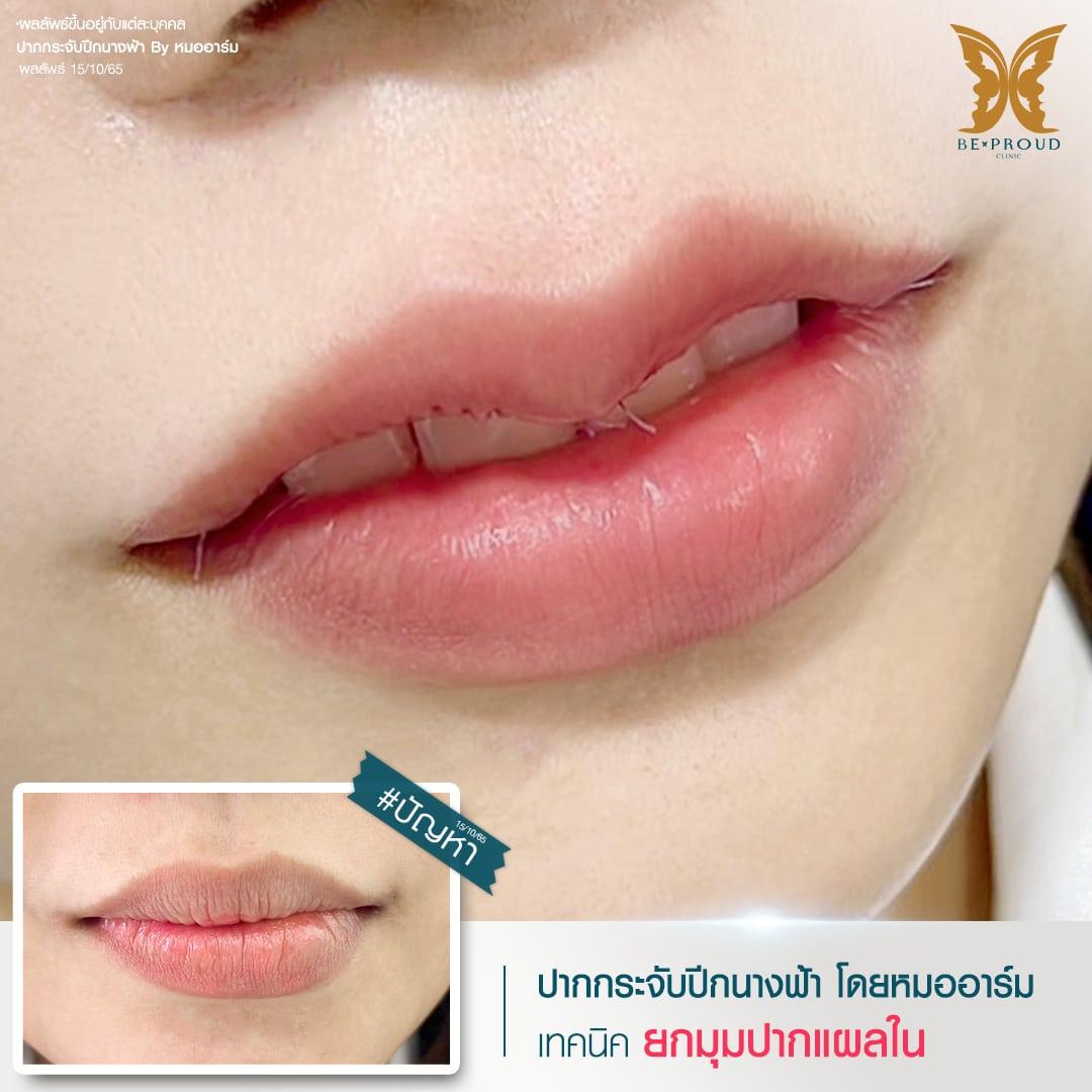 การผ่าตัดยกมุมปากแผลใน เทคนิคเฉพาะของหมออาร์ม  บีพราวด์ คลินิก