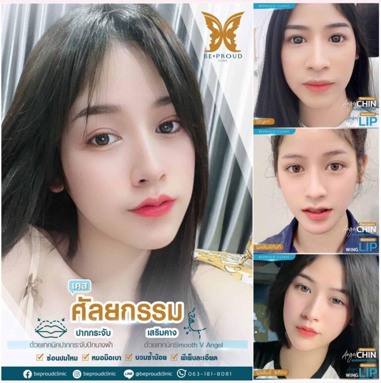 รีวิวตัดปากกระจับ แก้รูปปากไม่สมดุล