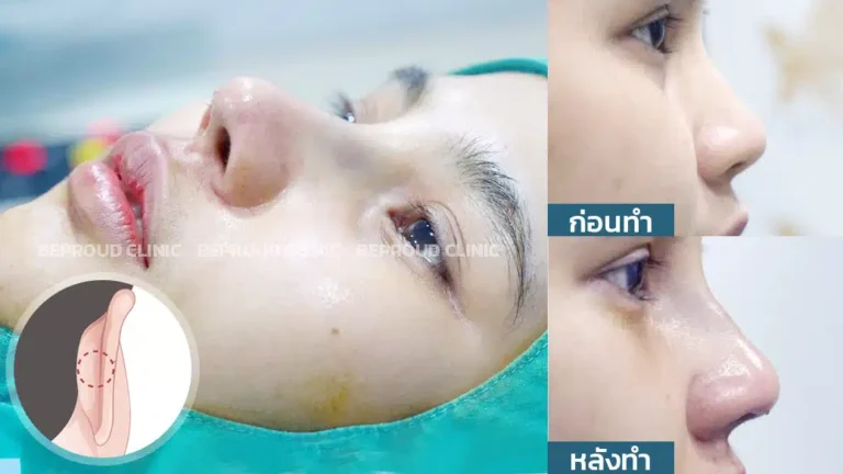 เสริมจมูกรองกระดูกอ่อนหลังหู