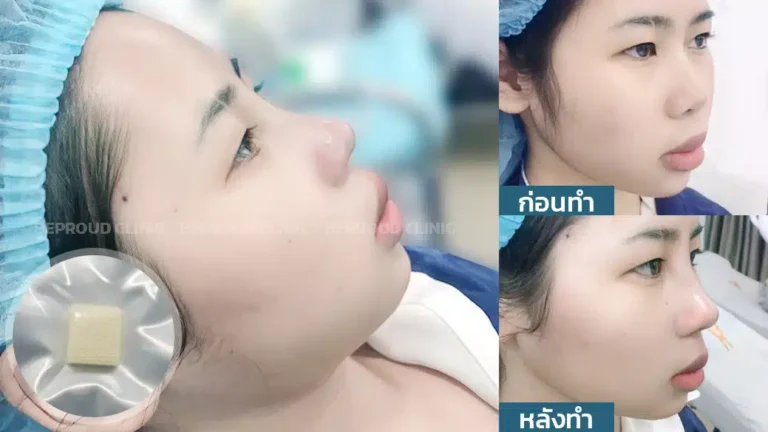 เทคนิคเสริมจมูก รองเนื้อเยื่อเทียม