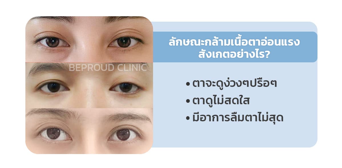 ลักษณะกล้ามเนื้อตาอ่อนแรงดูอย่างไร