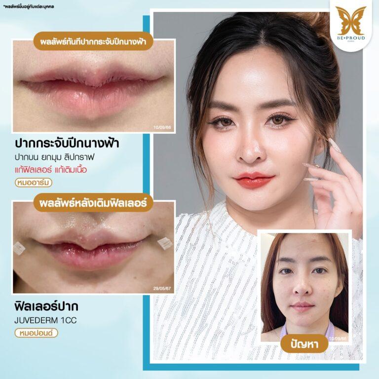 รีวิวเติมฟิลเลอร์ปากหลังตัดปากกระจับ