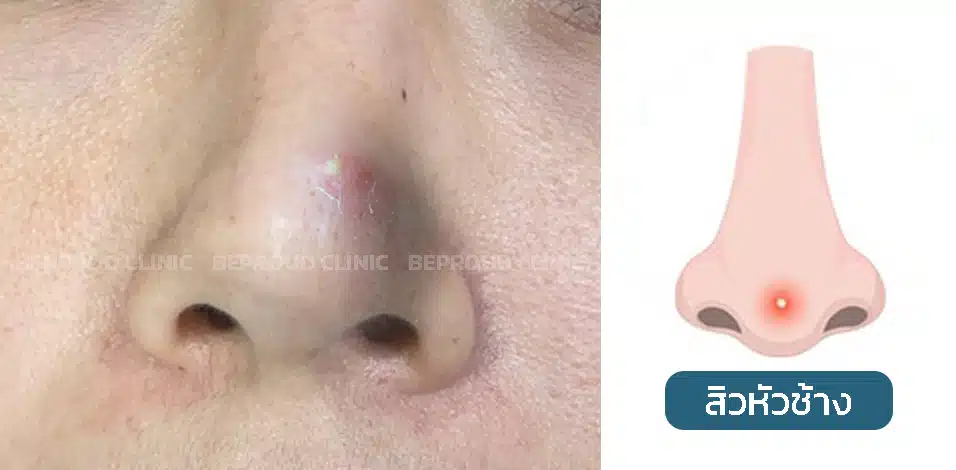 เช็คอาการ!! ก่อนซิลิโคนจมูกทะลุ มีสิวหัวช้างขึ้นที่ปลายจมูก