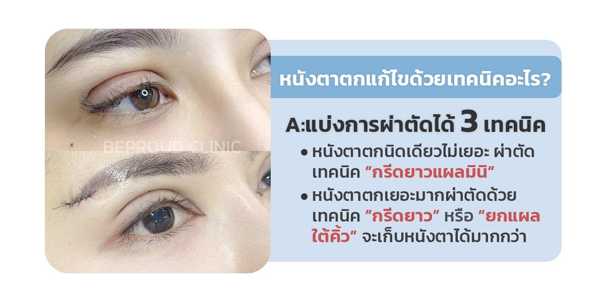 หนังตาตก ควรผ่าตัดด้วยเทคนิคแบบไหน