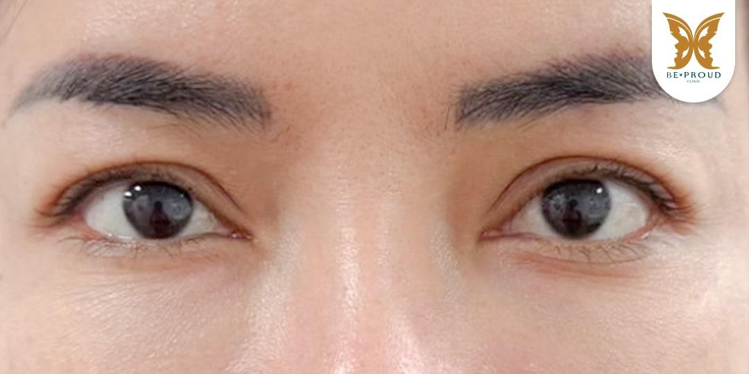 หนังตาตกทำไงดี? แก้ไขปัญหาตาปรือและเพิ่มความมั่นใจ