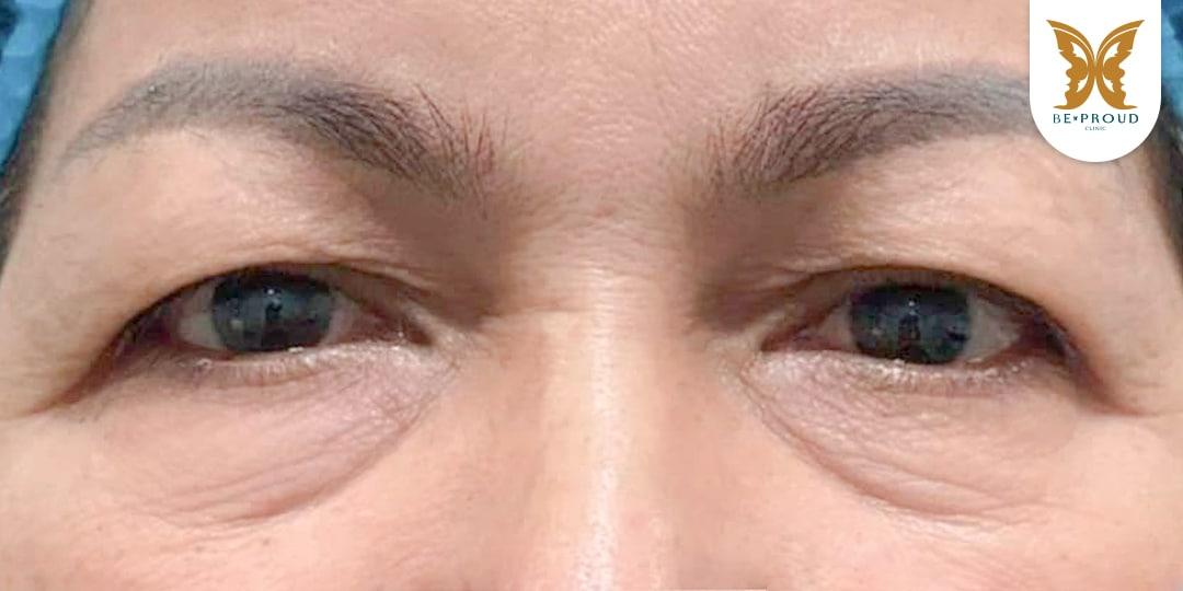 หนังตาตกทำไงดี? แก้ไขปัญหาตาปรือและเพิ่มความมั่นใจ