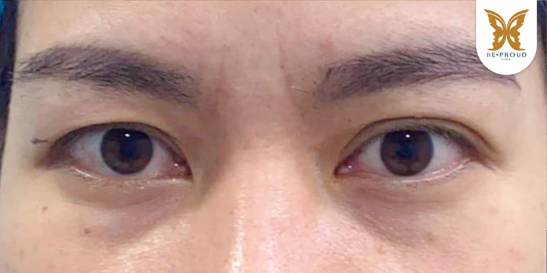 หนังตาตกทำไงดี? แก้ไขปัญหาตาปรือและเพิ่มความมั่นใจ