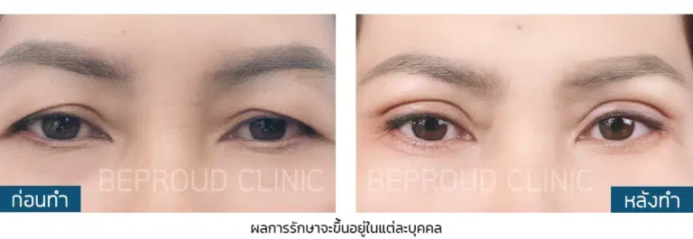 ก่อนทำ-หลังทำ เทคนิคผ่าตัดยกหางหงส์