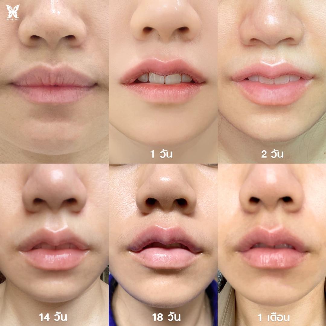 ทำปากกระจับกี่วันหาย เข้าที่ตอนไหน