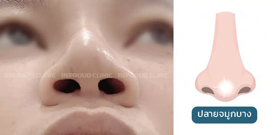 เช็คอาการ!! ก่อนซิลิโคนจมูกทะลุ ปลายจมูกบางใส