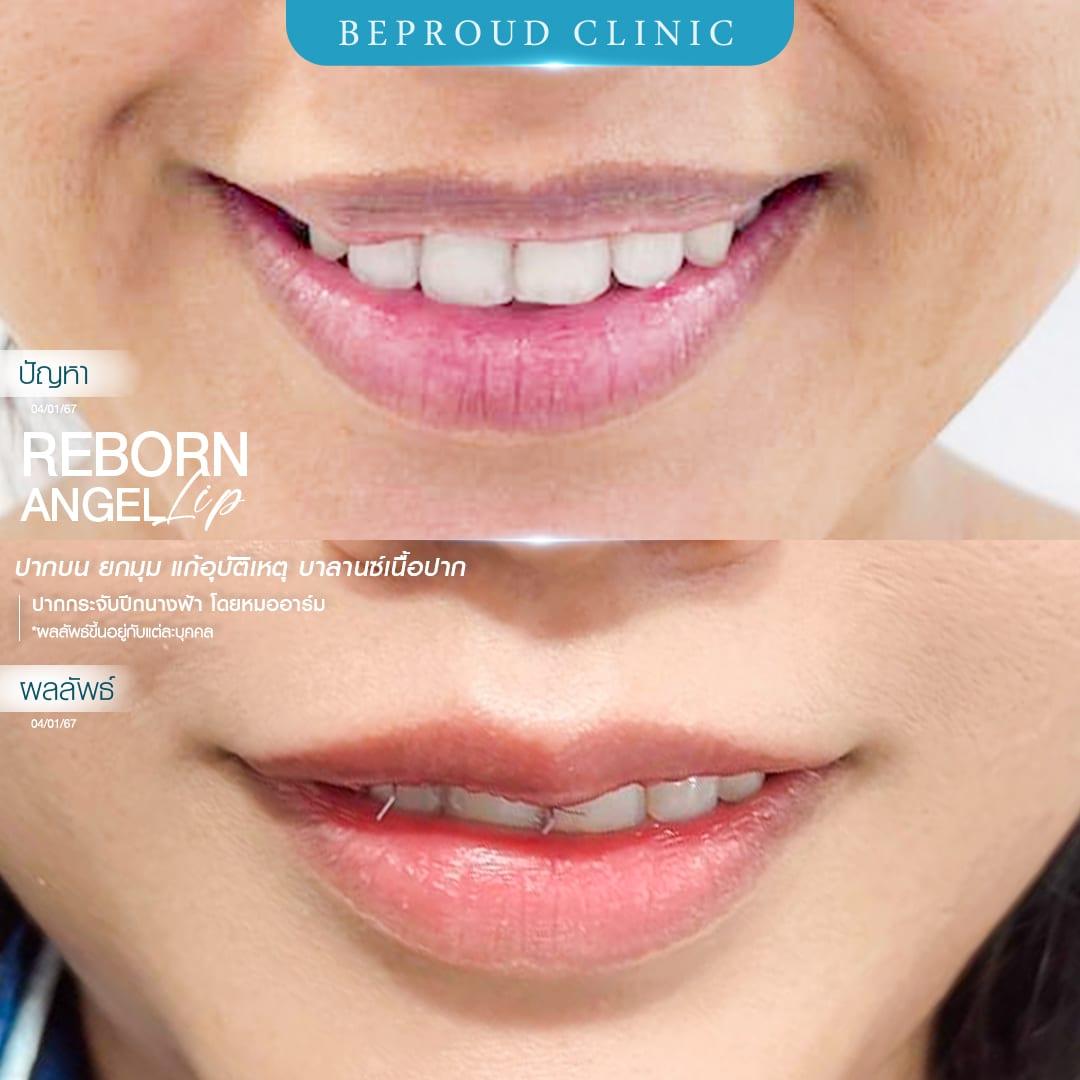 ศัลยกรรมปากกระจับ เพิ่มความมั่นใจในการพูดและยิ้ม