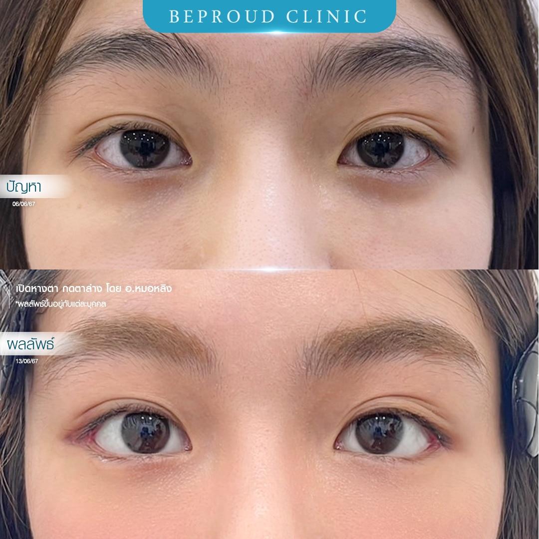 เปิดหางตา โดยจักษุแพทย์เฉพาะทาง