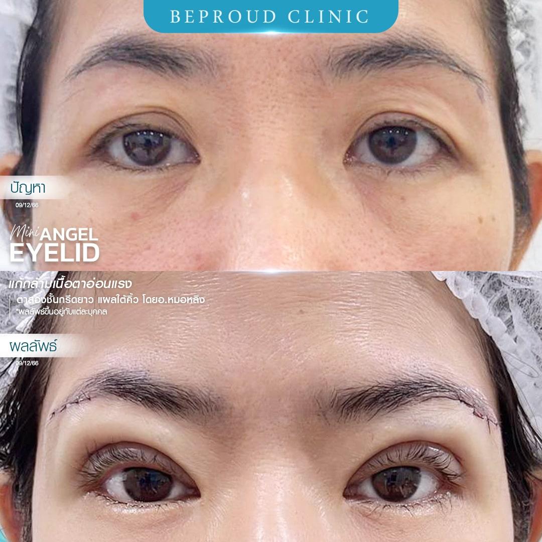 หนังตาตกทำไงดี? แก้ไขปัญหาตาปรือและเพิ่มความมั่นใจ