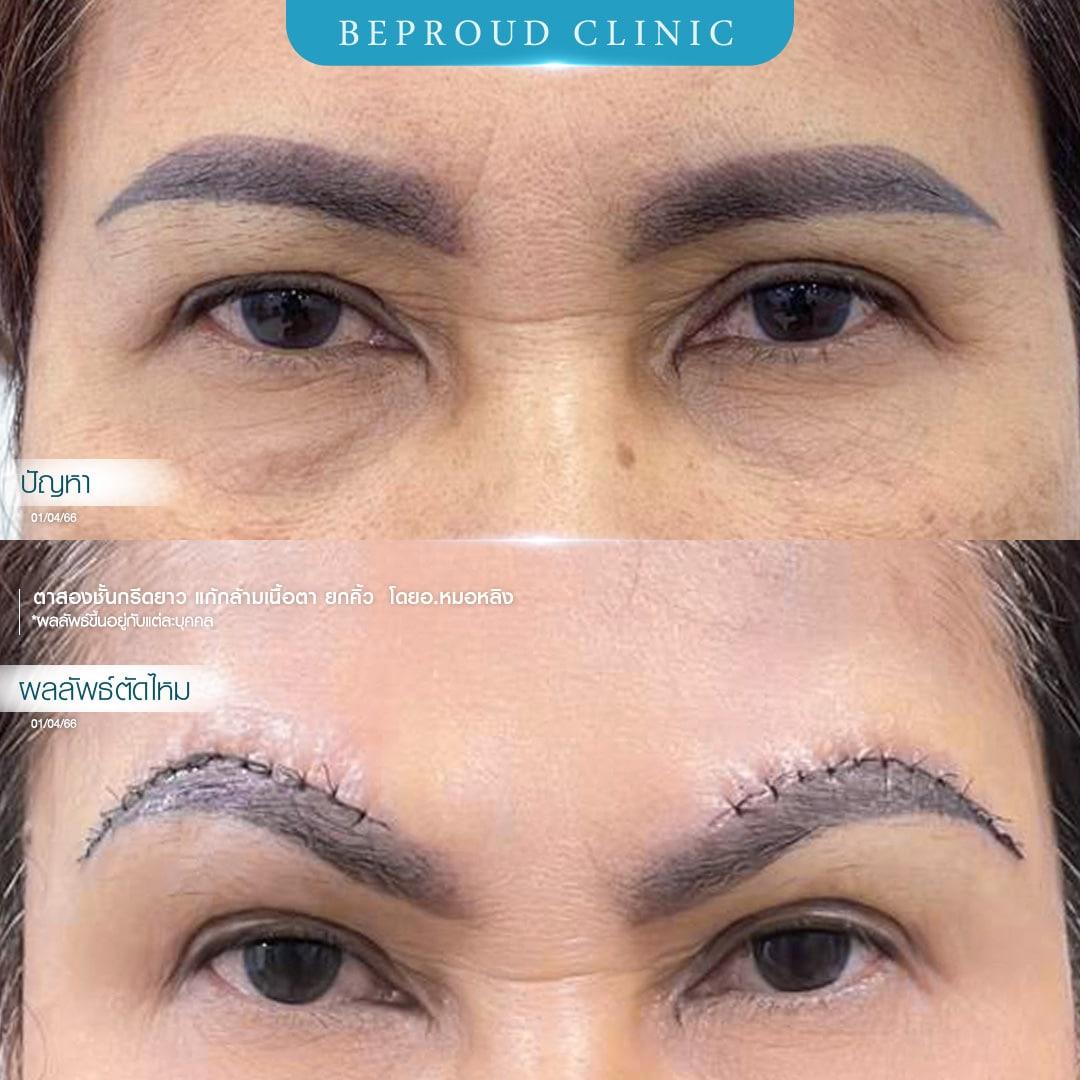 การผ่าตัดยกคิ้ว (Direct-Brow Lift)