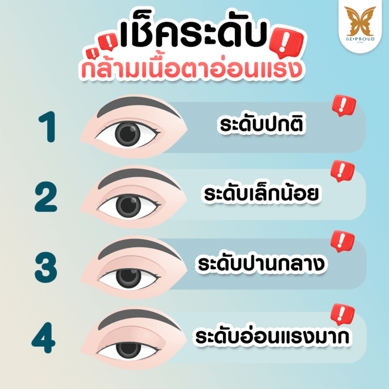 เช็คระดับกล้ามเนื้อตาอ่อนแรง