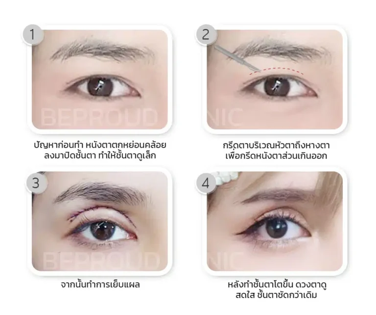 ขั้นตอนการผ่าตัด เทคนิคกรีดตายาว