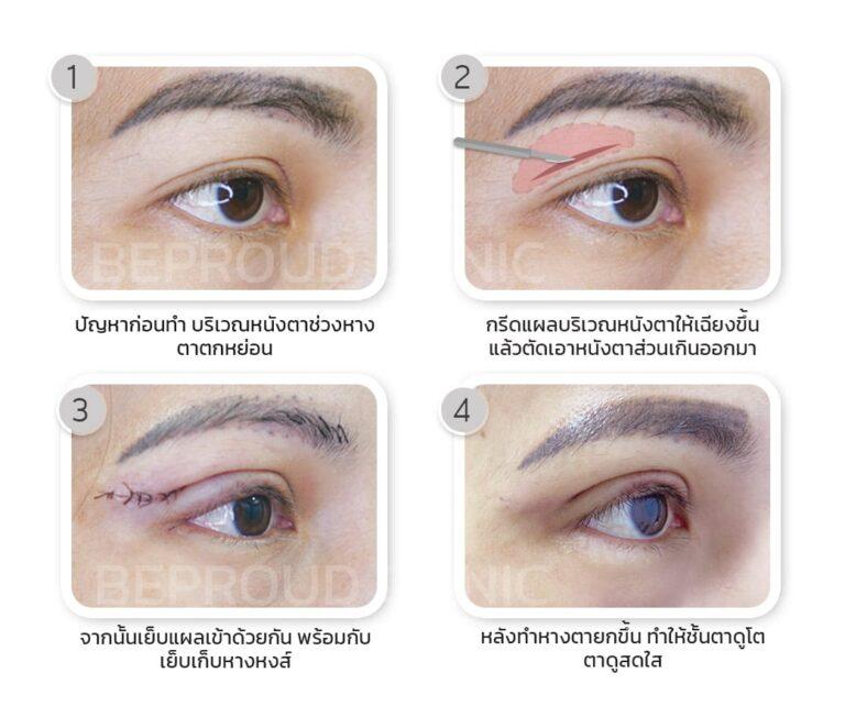 ขั้นตอนการผ่าตัดเทคนิคยกหางหงส์