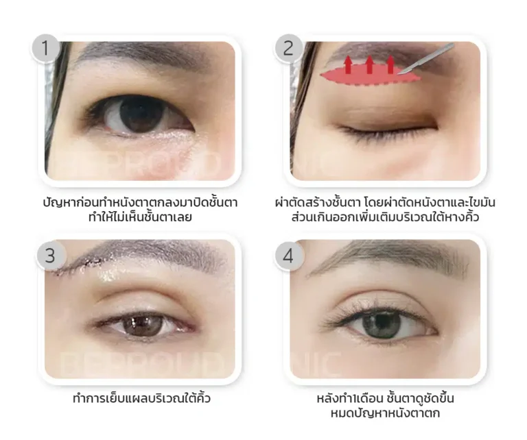 ขั้นตอนผ่าตัด เทคนิคยกหางตาแผลใต้คิ้ว