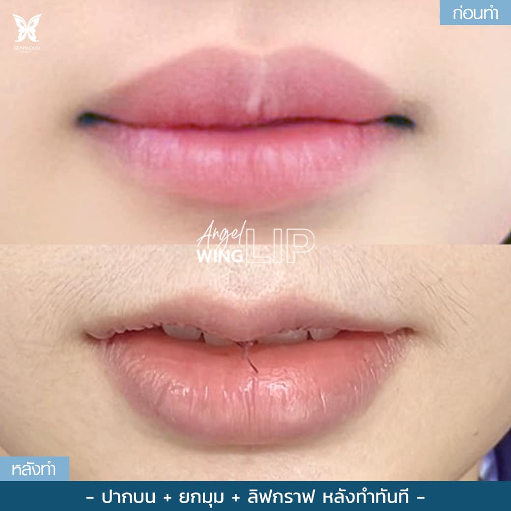 ศัลยกรรมปากกระจับ ริมฝีปากสองข้างไม่เท่ากัน