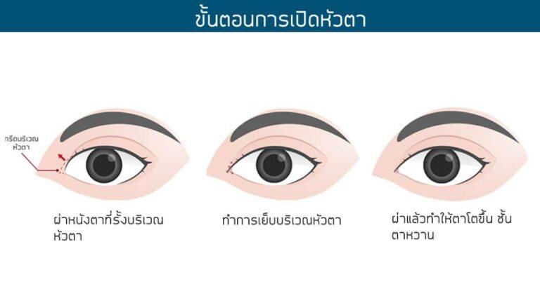 ขั้นตอนการเปิดหัวตา