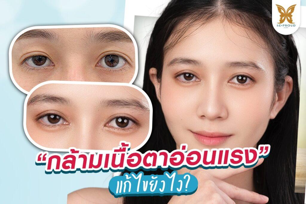 แก้ไขกล้ามเนื้อตาอ่อนแรง