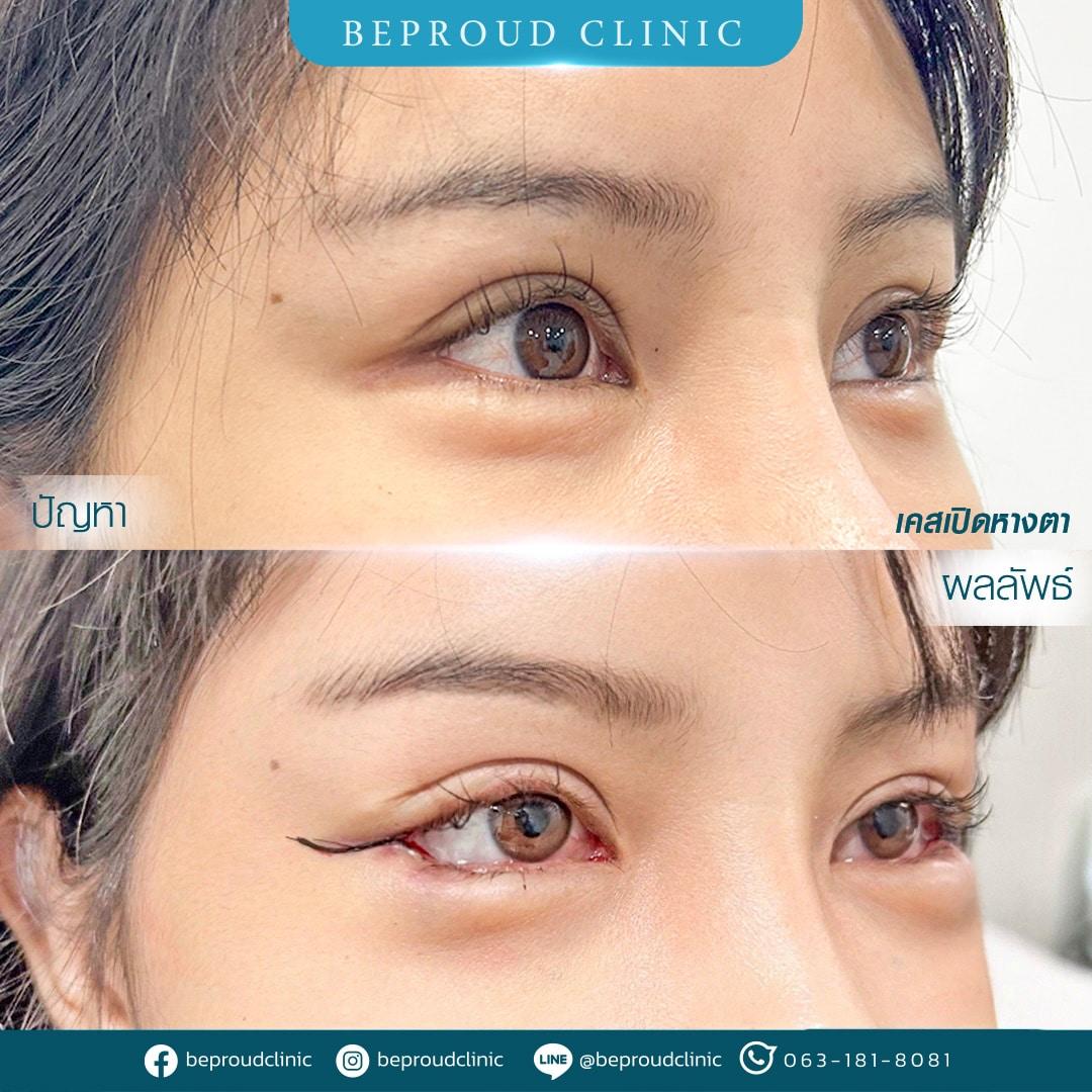 เปิดหางตา บีพราวด์คลินิก