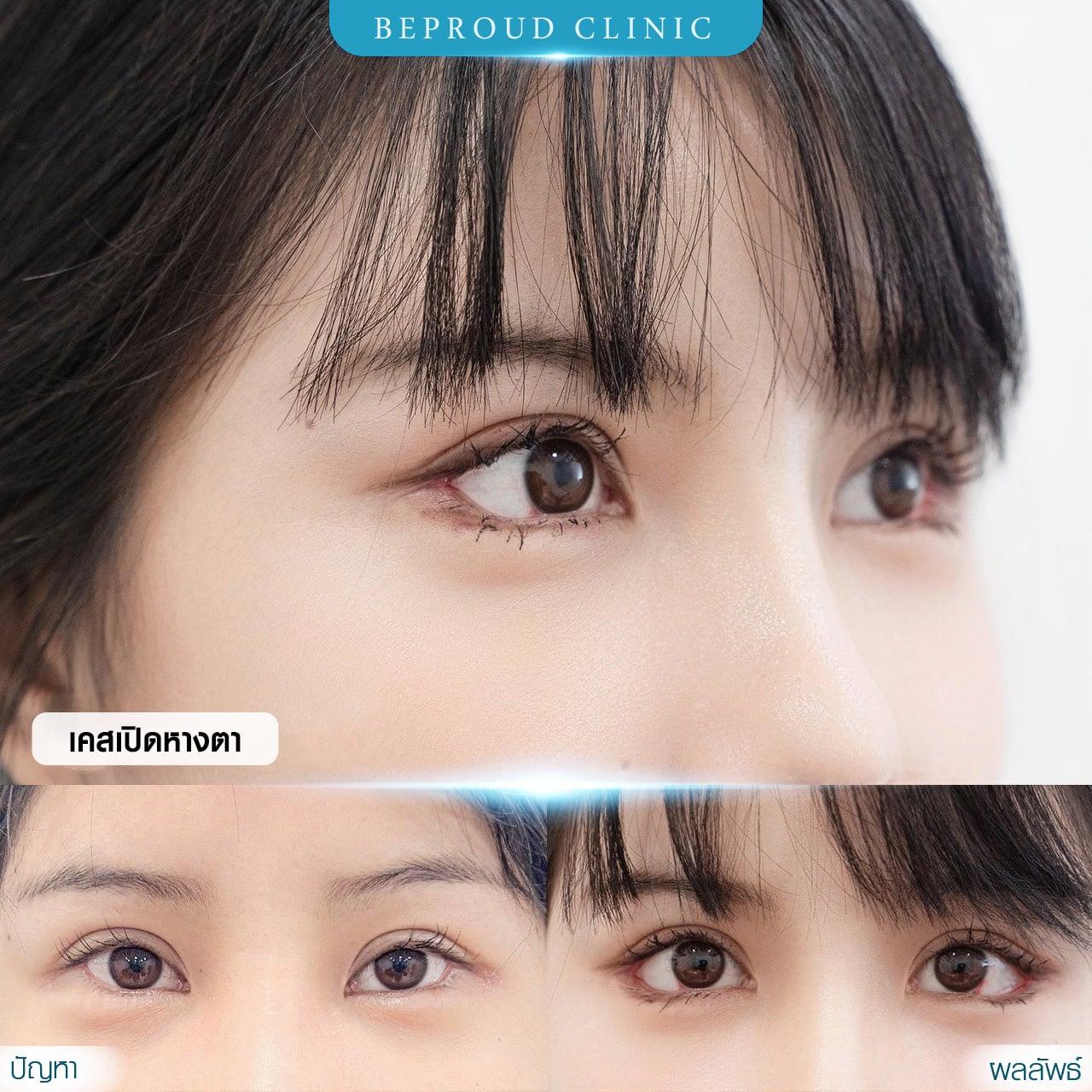 เปิดหางตา Beproud Clinic