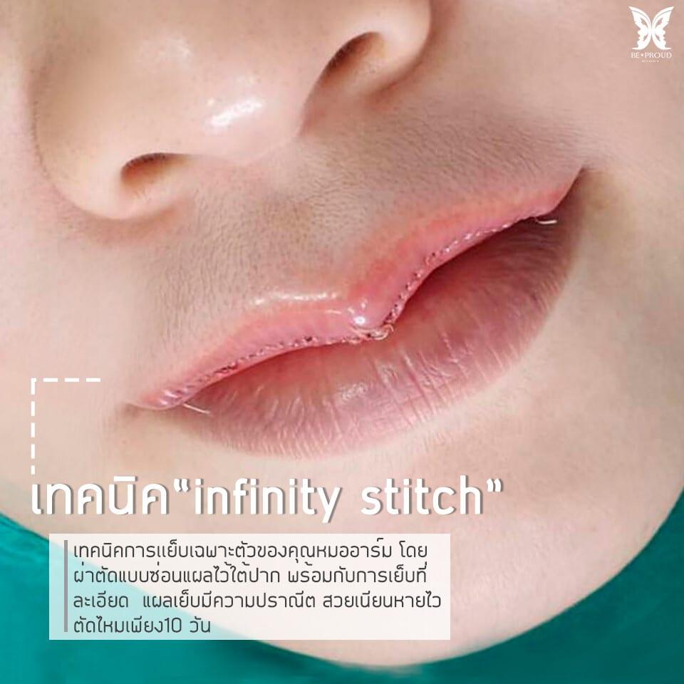เทคนิค “infinity Stitch