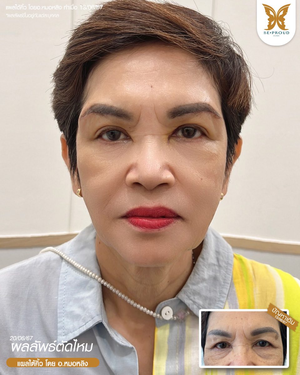 แก้หนังตาตก