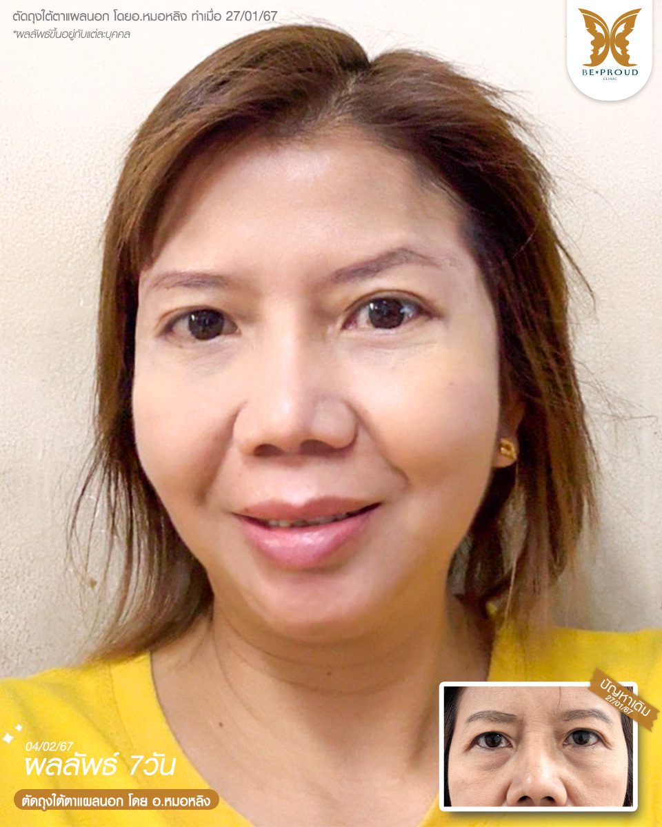 แก้หนังตาตก