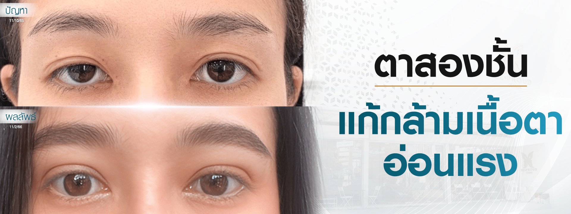 ตาสองชั้น บริการ ตาสองชั้นแก้กล้ามเนื้อตาอ่อนแรง