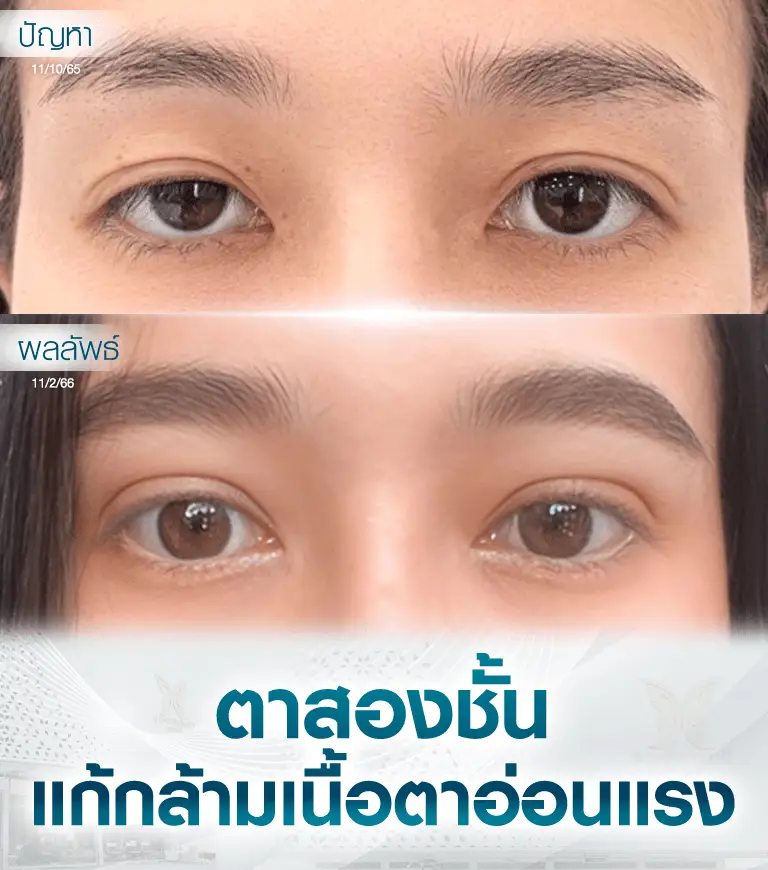 หัตถการตาสองชั้นแก้กล้ามเนื้อตาอ่อนแรง บีพราวด์