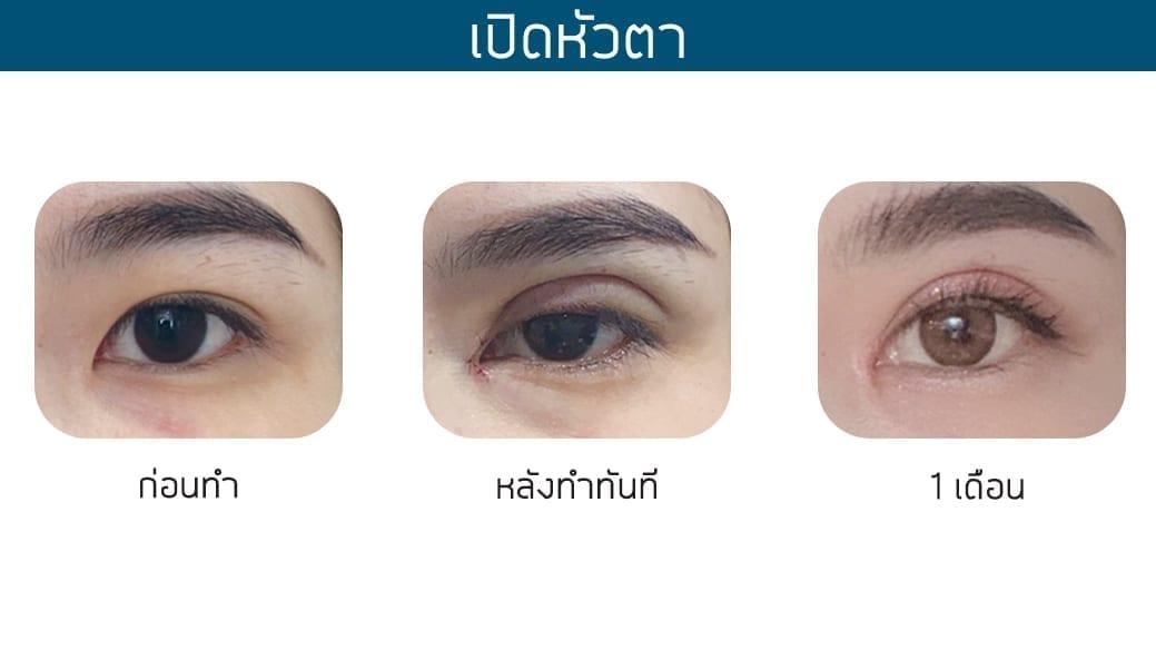 ผลลัพธ์ เปิดหัวตา