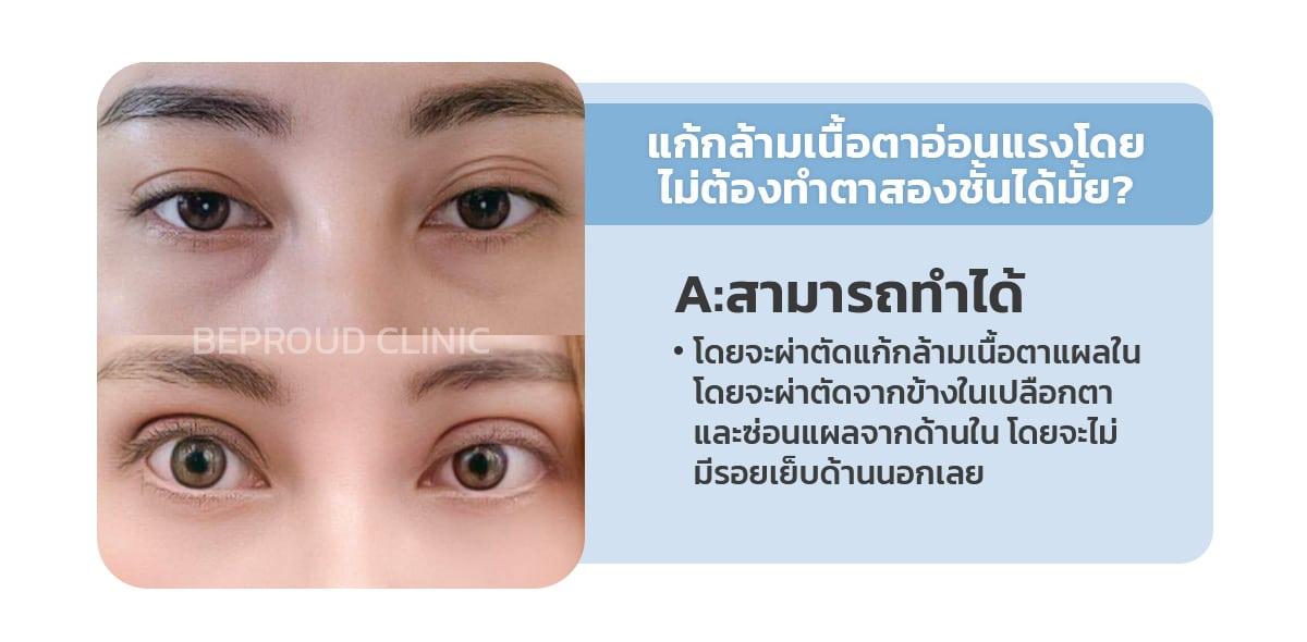 กล้ามเนื้อตาอ่อนแรง ทำตาสองชั้นได้มั้ย
