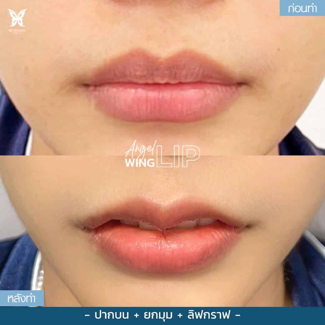 ศัลยกรรมปากกระจับ ริมฝีปากบนตรง ไม่โค้งเว้า