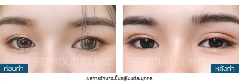 ก่อนทำ-หลังทำ เทคนิคผ่าตัดกรีดตายาวแผลมินิ