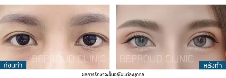 ก่อนทำ-หลังทำ เทคนิคผ่าตัดกรีดตายาวแผลมินิ