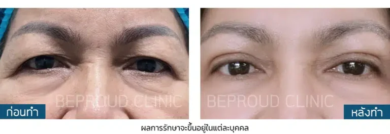 ก่อนทำ-หลังทำ เทคนิคผ่าตัดยกหางตาแผลใต้คิ้ว