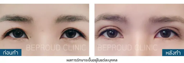 ก่อนทำ-หลังทำ เทคนิคผ่าตัดยกหางตาแผลใต้คิ้ว