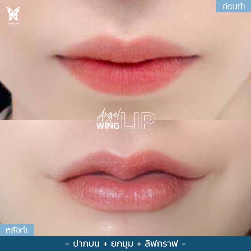 ศัลยกรรมปากกระจับ ให้รูปปากเข้ากับโครงหน้า