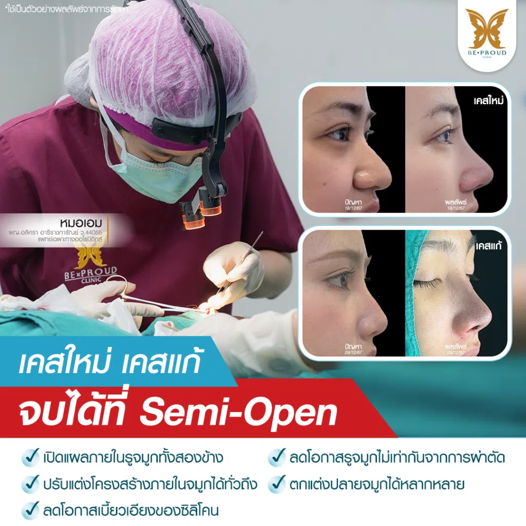ฺเสริมจมูก Bproud Clinic