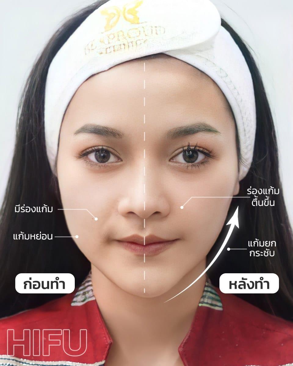 ยกกระชับผิว ด้วย Ultra Lift