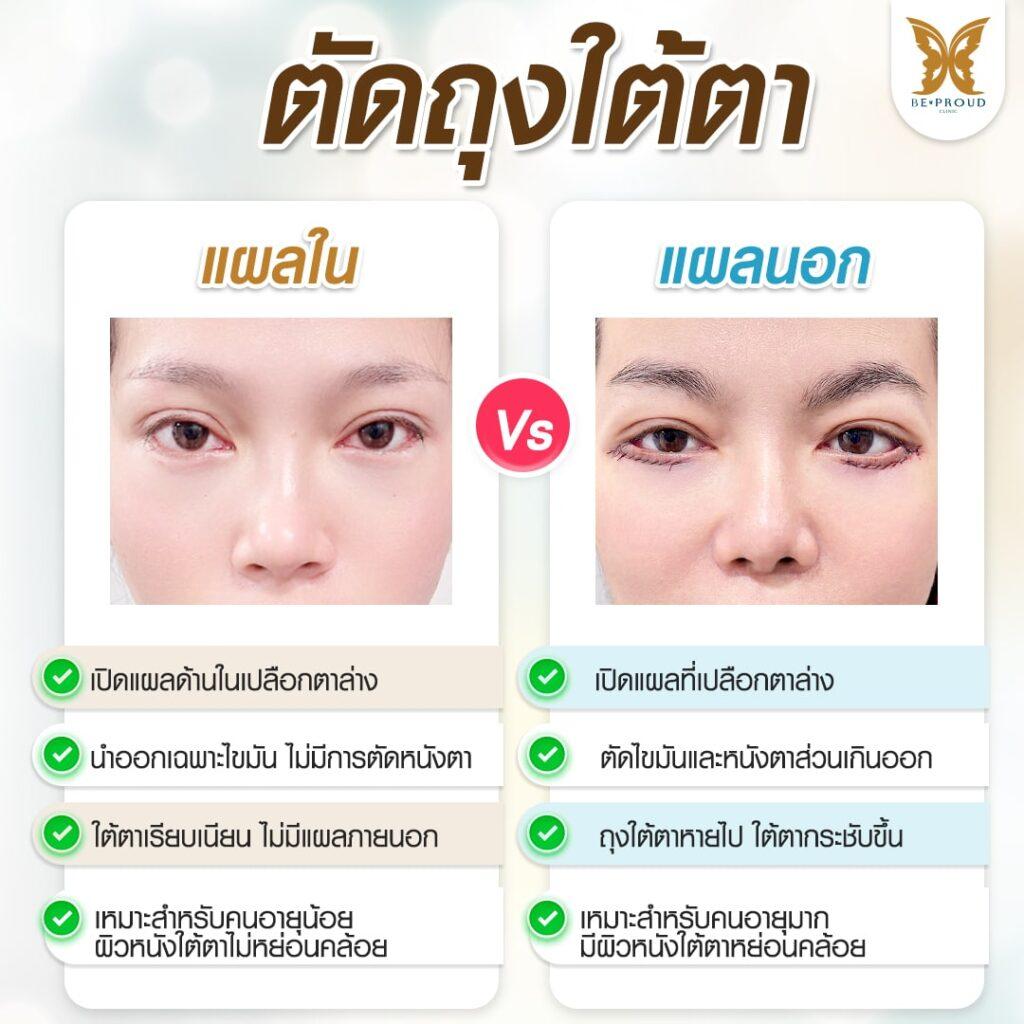 ตัดถุงใต้ตา แผลนอก แผลใน