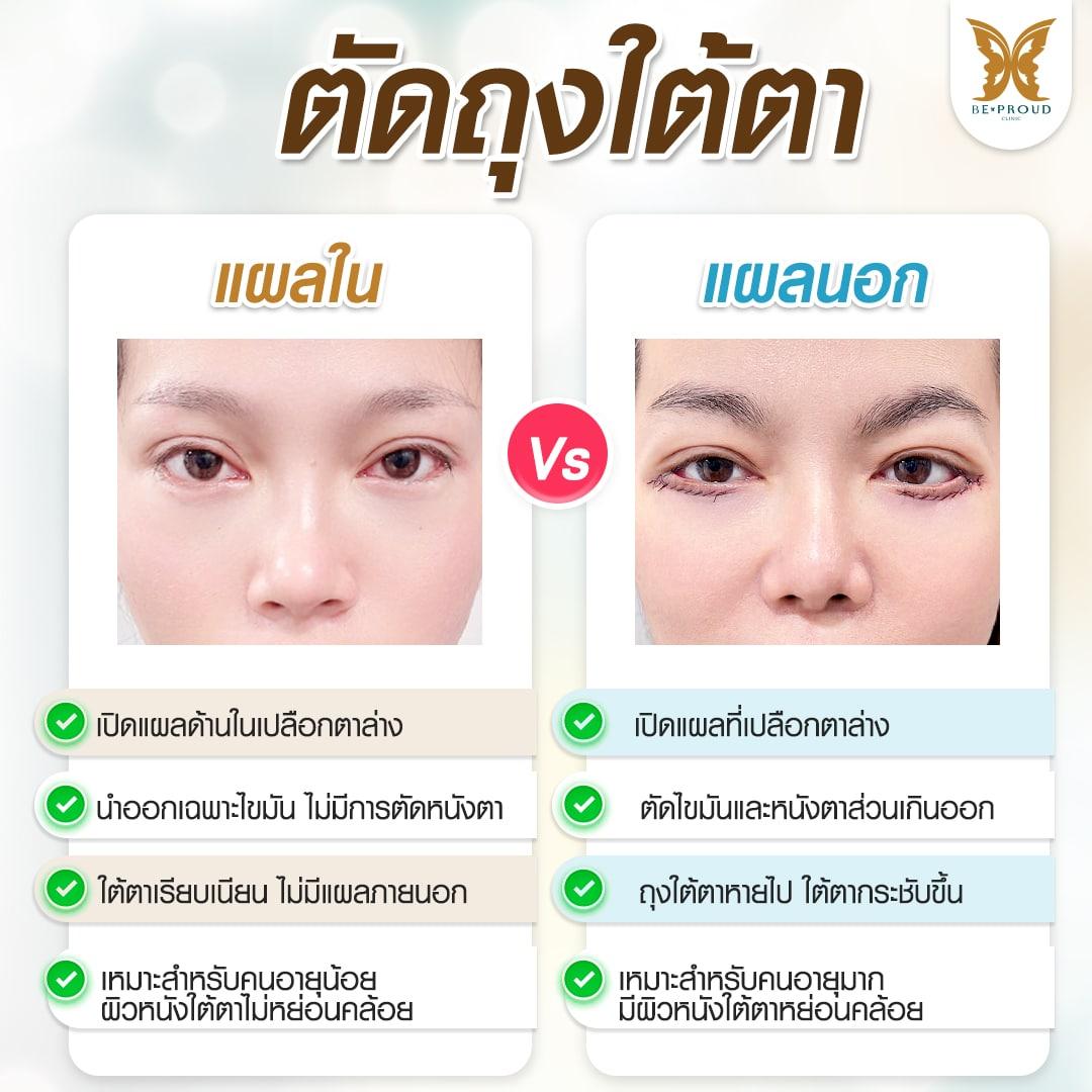 ตัดถุงใต้ตา แผลนอก แผลใน