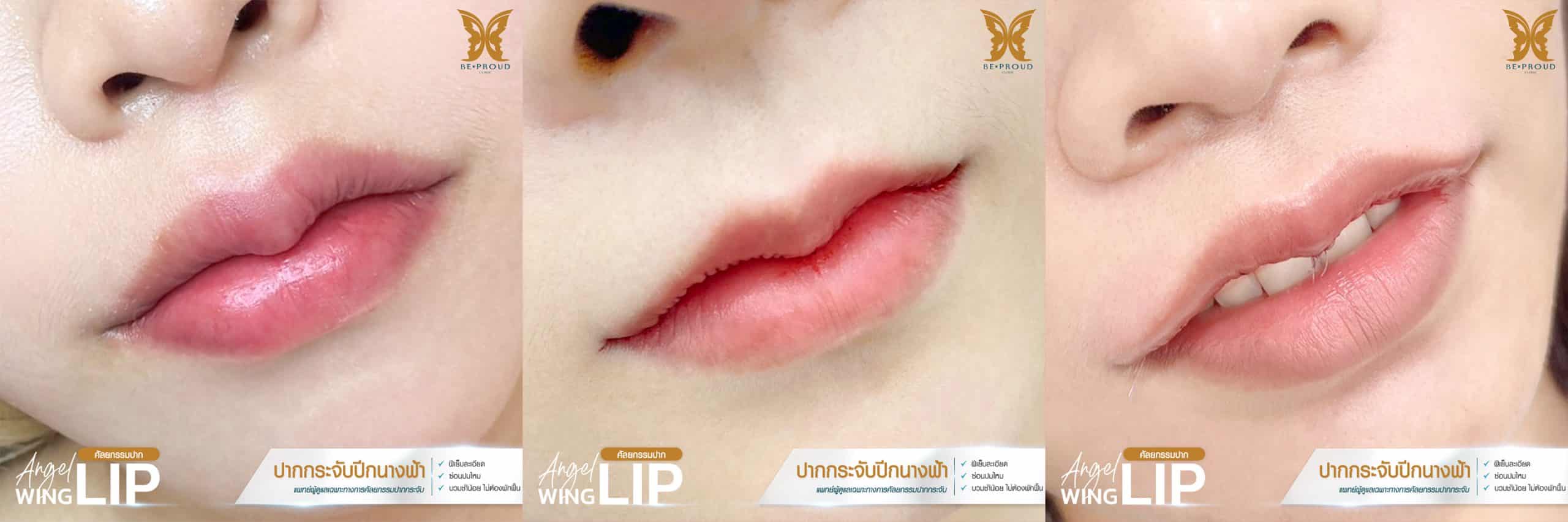 ปากกระจับปีกนางฟ้า บีพราวด์ เทคนิค “infinity stitch”