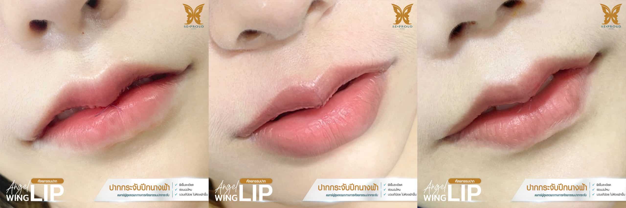 ปากกระจับปีกนางฟ้า บีพราวด์ เทคนิค “infinity stitch”